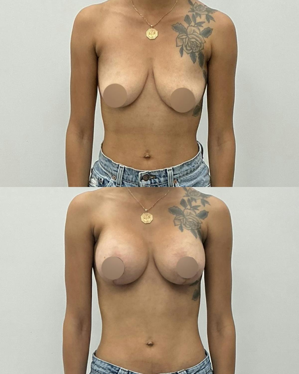 Breast Lift Before & After Gallery - Patient 298794 - Image 1