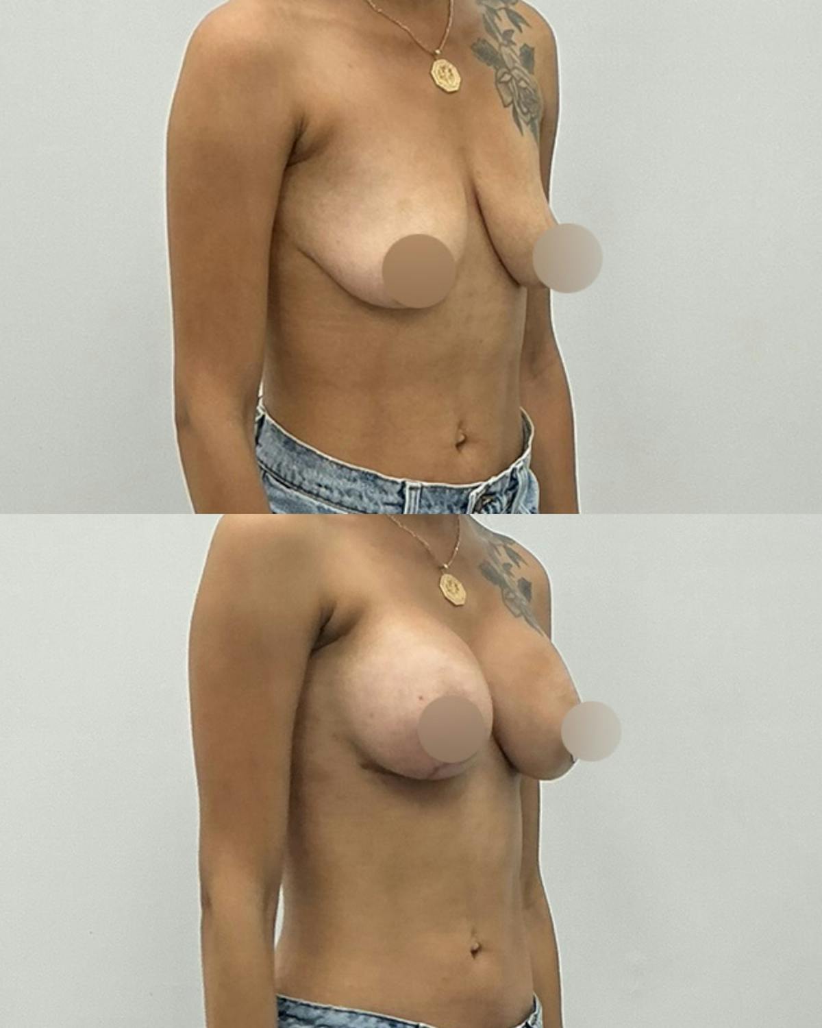 Breast Lift Before & After Gallery - Patient 298794 - Image 2
