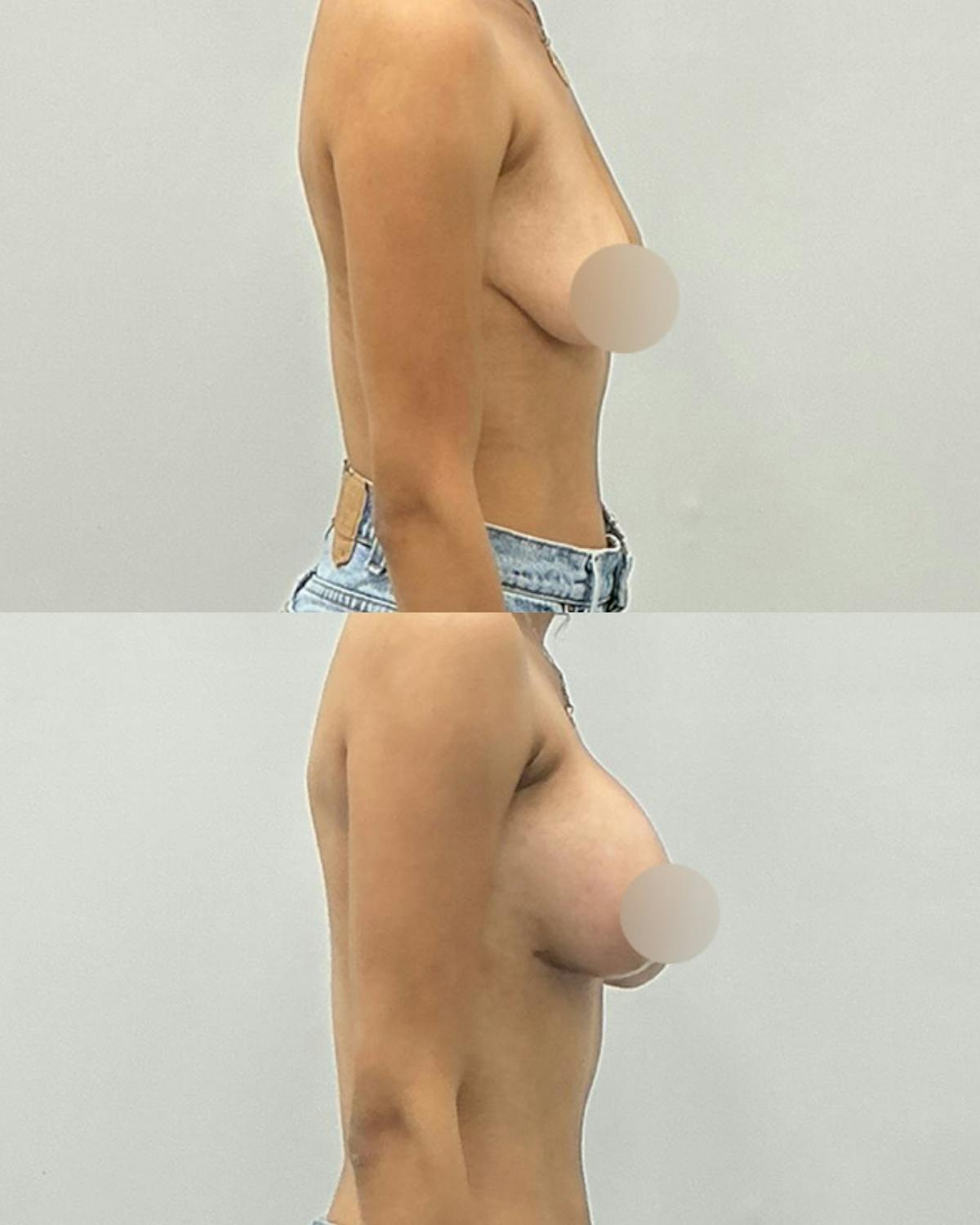 Breast Lift Before & After Gallery - Patient 298794 - Image 3