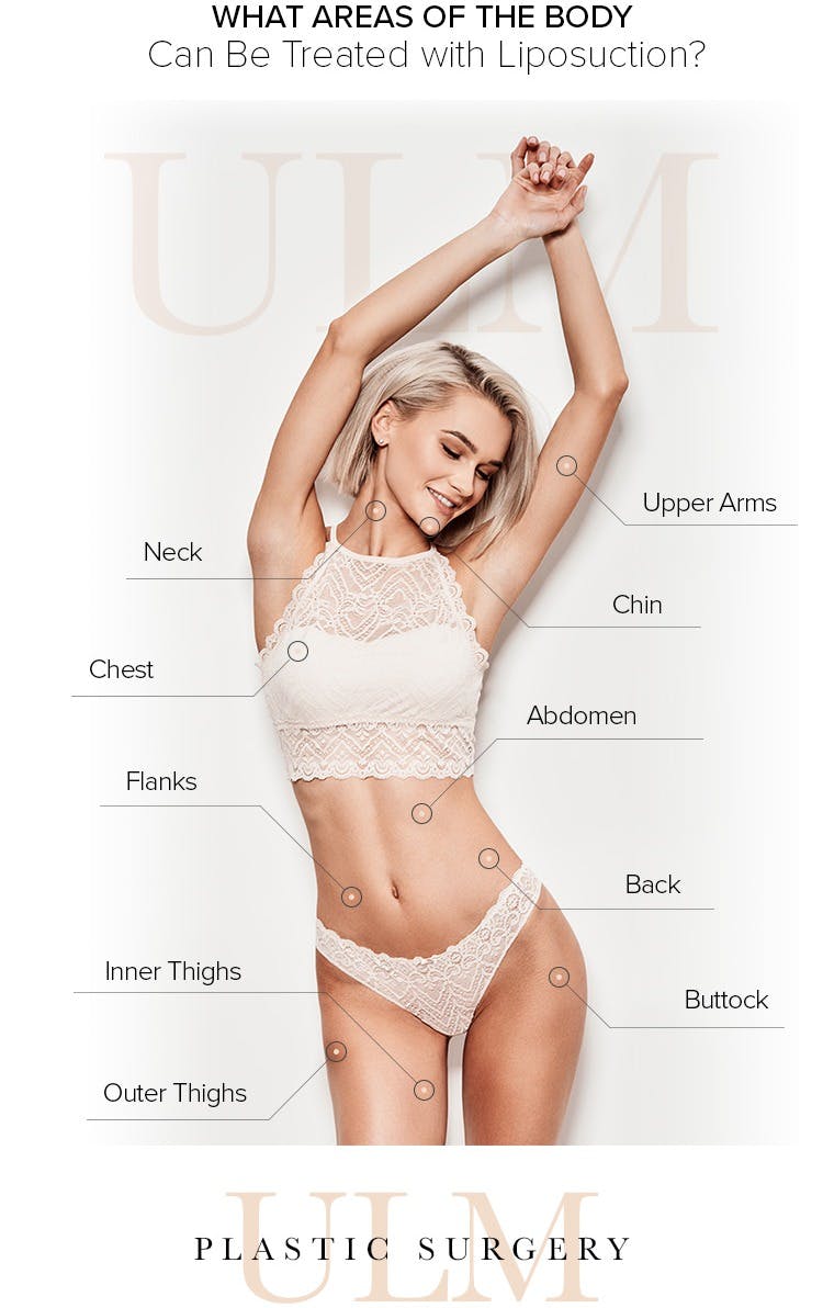 liposuction chart
