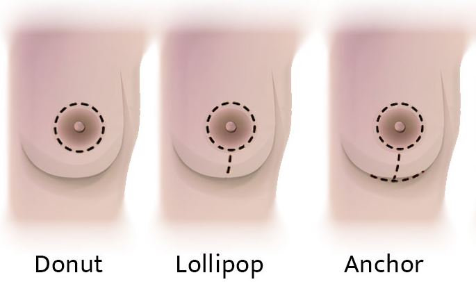 Lollipop Incision Breast Lift in Charleston, SC | Mastopexy | Ulm Plastic Surgery