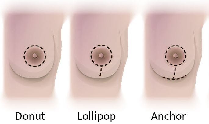 breast lift graphic