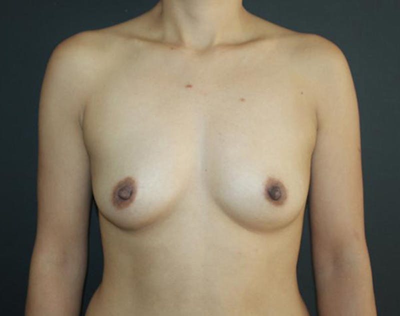 Breast Augmentation Before & After Gallery - Patient 289740 - Image 1