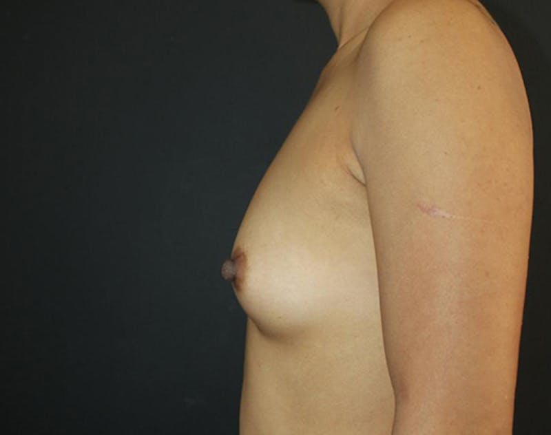Breast Augmentation Before & After Gallery - Patient 289740 - Image 9