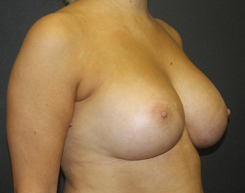 Breast Augmentation Before & After Gallery - Patient 423101 - Image 4