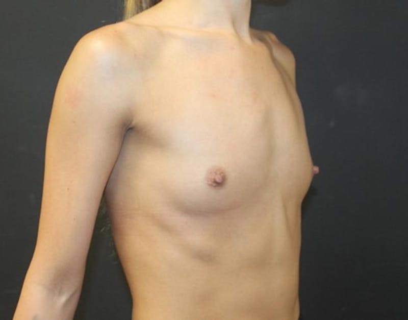 Breast Augmentation Before & After Gallery - Patient 162074 - Image 3