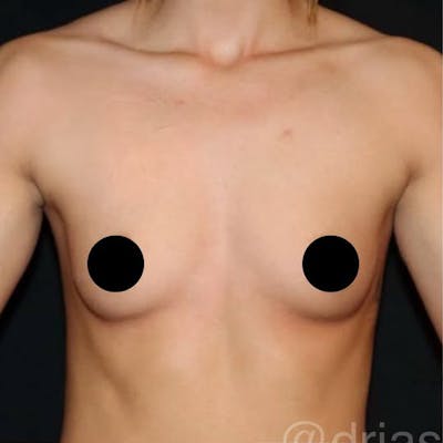 Breast Augmentation Before & After Gallery - Patient 198378 - Image 1