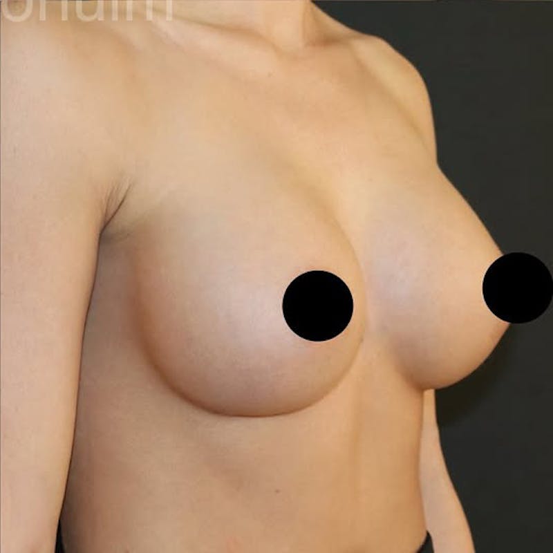 Breast Augmentation Before & After Gallery - Patient 198378 - Image 4