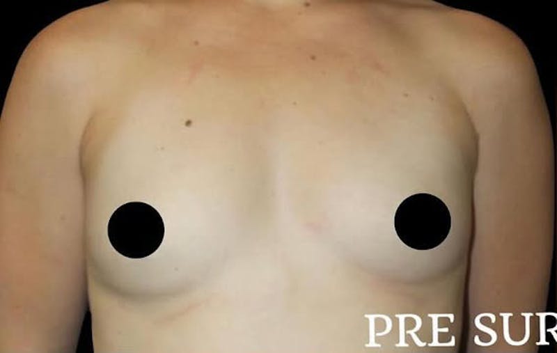 Breast Augmentation Before & After Gallery - Patient 377493 - Image 1