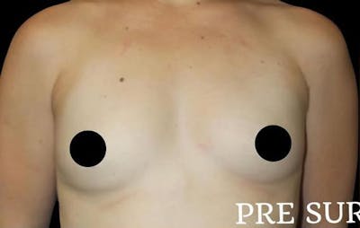 Breast Augmentation Before & After Gallery - Patient 377493 - Image 1