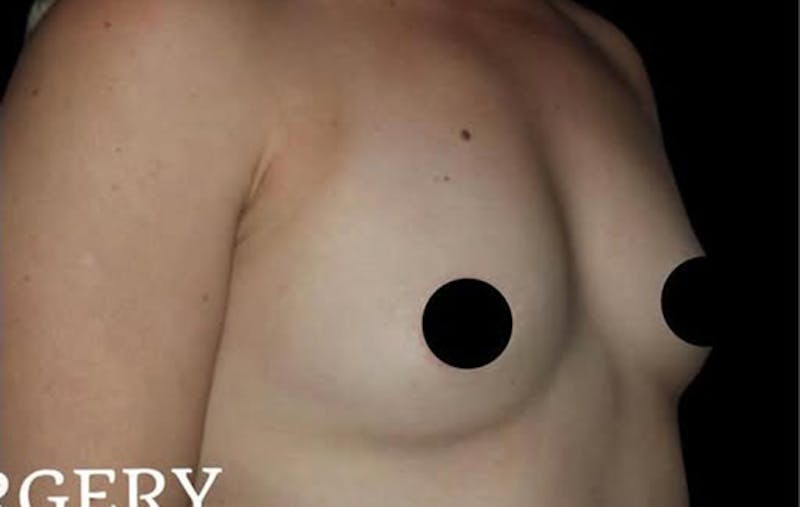 Breast Augmentation Before & After Gallery - Patient 377493 - Image 5