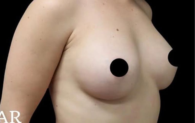 Breast Augmentation Before & After Gallery - Patient 377493 - Image 8
