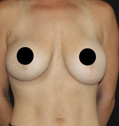 Breast Augmentation Before & After Gallery - Patient 392500 - Image 1