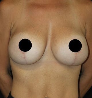 Breast Augmentation Before & After Gallery - Patient 392500 - Image 2