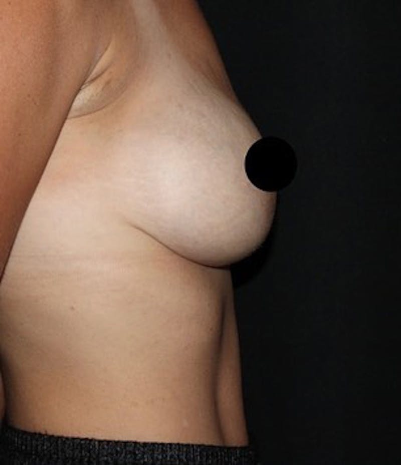 Breast Augmentation Before & After Gallery - Patient 392500 - Image 3
