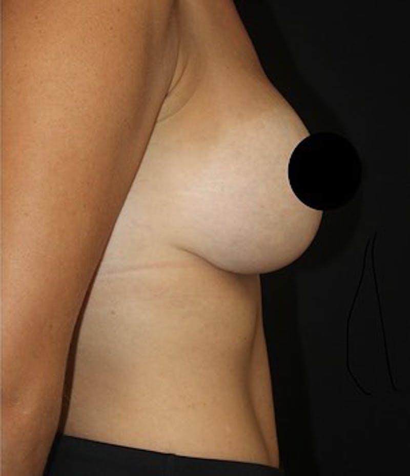 Breast Augmentation Before & After Gallery - Patient 392500 - Image 4