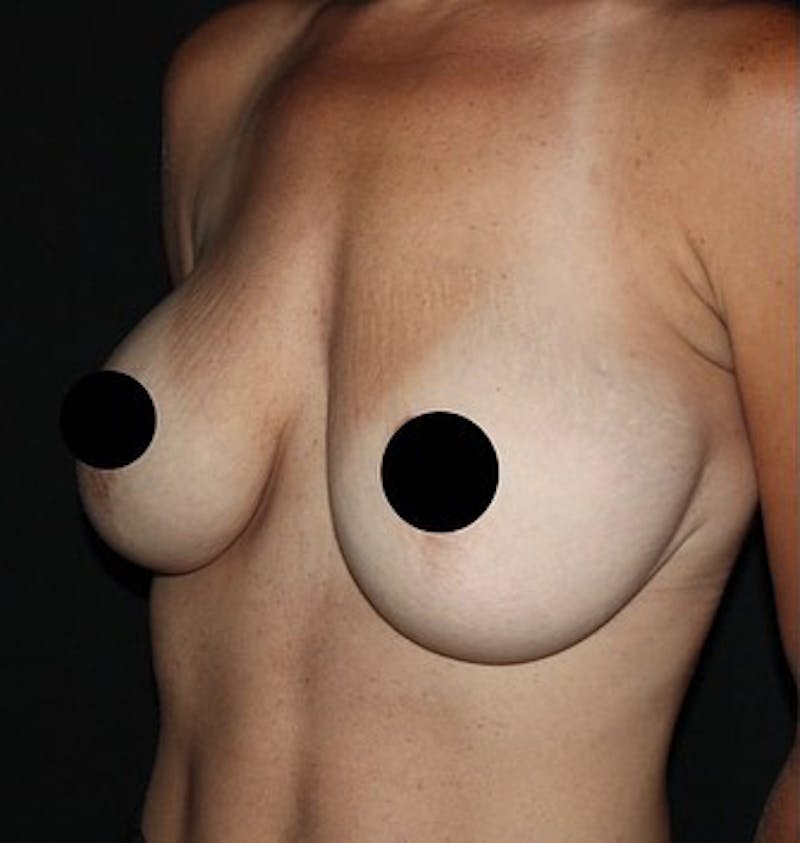 Breast Augmentation Before & After Gallery - Patient 392500 - Image 5