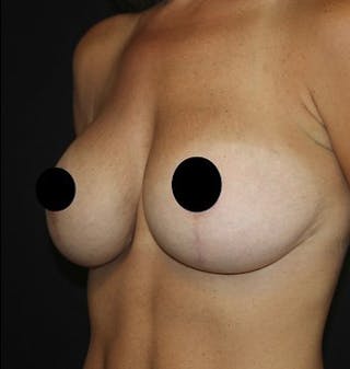 Breast Augmentation Before & After Gallery - Patient 392500 - Image 6