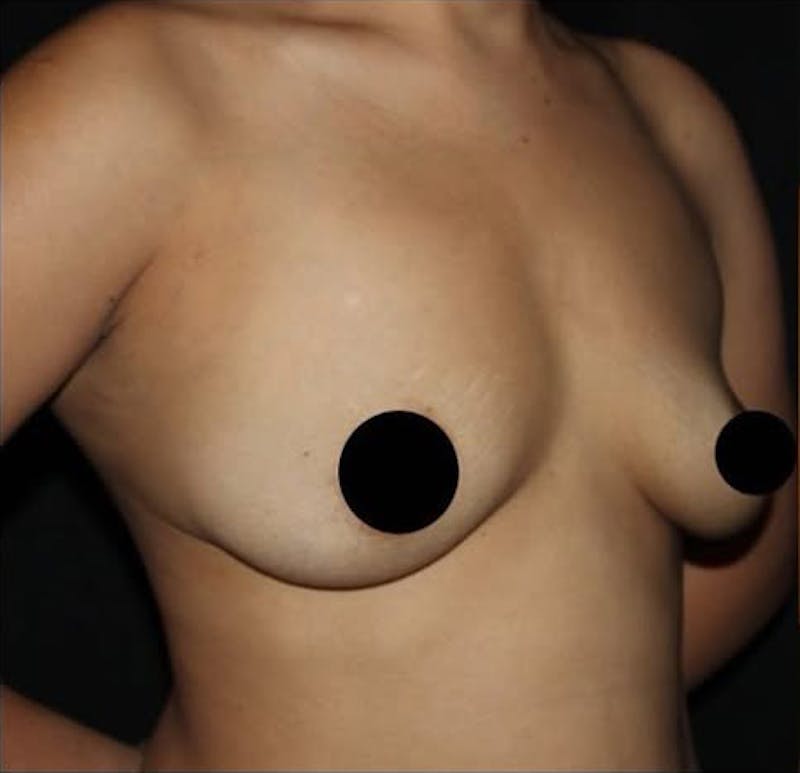Breast Augmentation Before & After Gallery - Patient 995138 - Image 3
