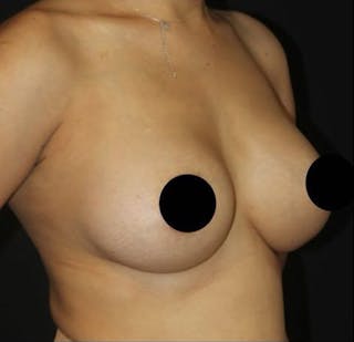 Breast Augmentation Before & After Gallery - Patient 995138 - Image 4