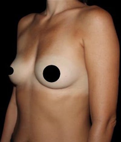 Breast Augmentation Before & After Gallery - Patient 162982 - Image 1