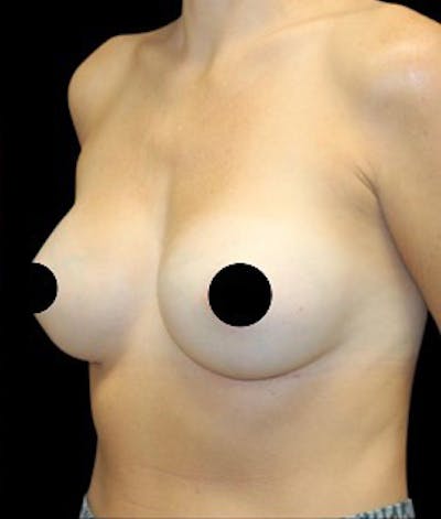 Breast Augmentation Before & After Gallery - Patient 162982 - Image 2