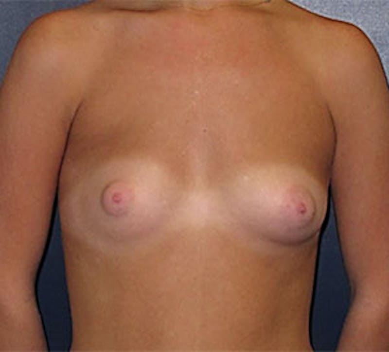 Breast Augmentation Before & After Gallery - Patient 101630 - Image 1