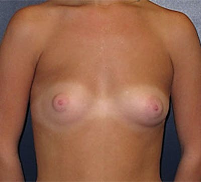 Breast Augmentation Before & After Gallery - Patient 101630 - Image 1