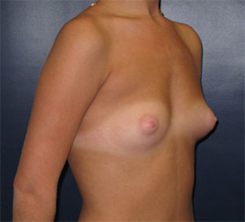 Breast Augmentation Before & After Gallery - Patient 101630 - Image 3