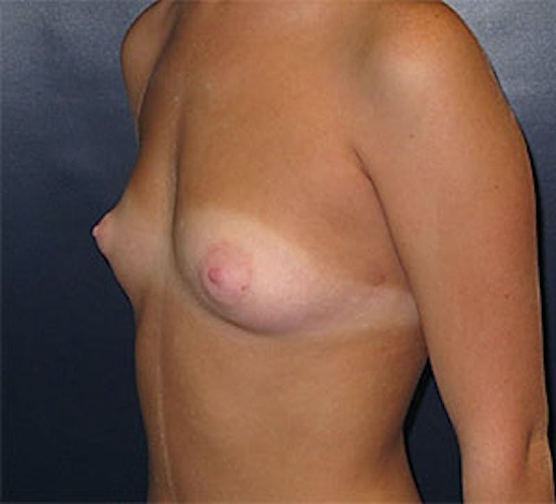 Breast Augmentation Before & After Gallery - Patient 101630 - Image 5