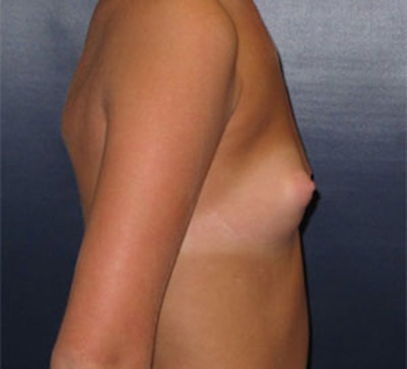 Breast Augmentation Before & After Gallery - Patient 101630 - Image 7