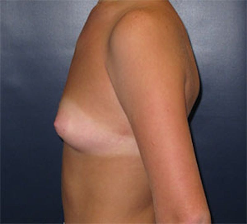 Breast Augmentation Before & After Gallery - Patient 101630 - Image 9