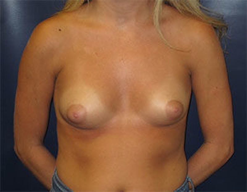 Breast Augmentation Before & After Gallery - Patient 317564 - Image 1