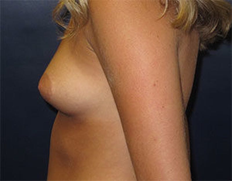 Breast Augmentation Before & After Gallery - Patient 317564 - Image 3