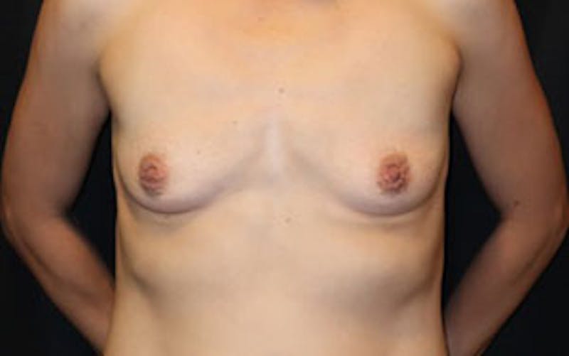 Breast Augmentation Before & After Gallery - Patient 248771 - Image 1