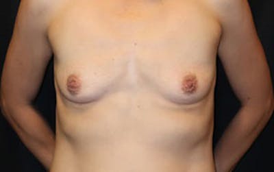 Breast Augmentation Before & After Gallery - Patient 248771 - Image 1
