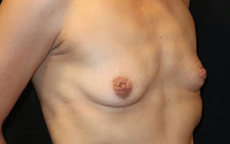 Breast Augmentation Before & After Gallery - Patient 248771 - Image 5
