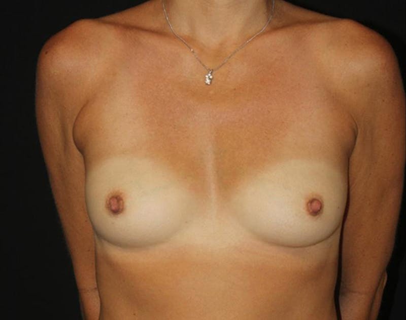 Breast Augmentation Before & After Gallery - Patient 891633 - Image 1