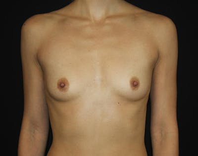 Breast Augmentation Before & After Gallery - Patient 330068 - Image 1
