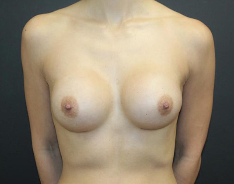 Breast Augmentation Before & After Gallery - Patient 330068 - Image 2