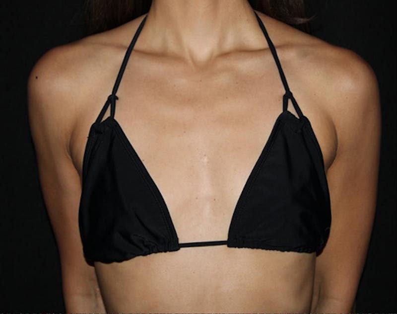 Breast Augmentation Before & After Gallery - Patient 330068 - Image 7