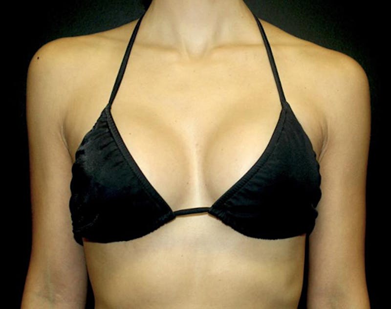 Breast Augmentation Before & After Gallery - Patient 330068 - Image 8