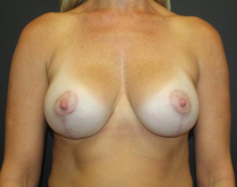 Breast Augmentation Before & After Gallery - Patient 292298 - Image 2