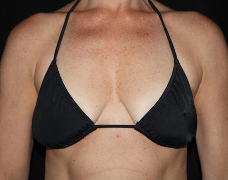 Breast Augmentation Before & After Gallery - Patient 292298 - Image 11