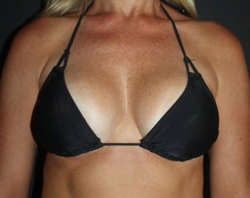 Breast Augmentation Before & After Gallery - Patient 292298 - Image 12
