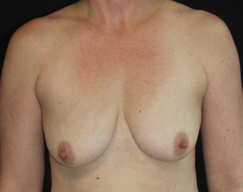 Breast Implants with Lift Before & After Gallery - Patient 169295 - Image 1