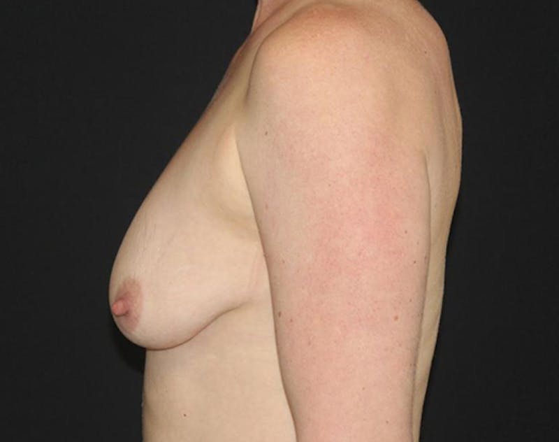Breast Implants with Lift Before & After Gallery - Patient 169295 - Image 9