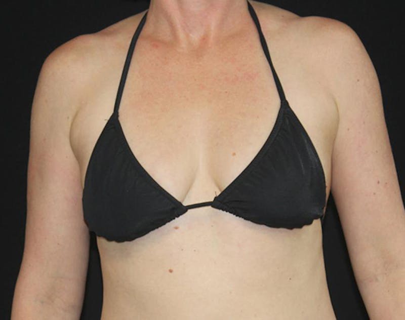 Breast Implants with Lift Before & After Gallery - Patient 169295 - Image 11