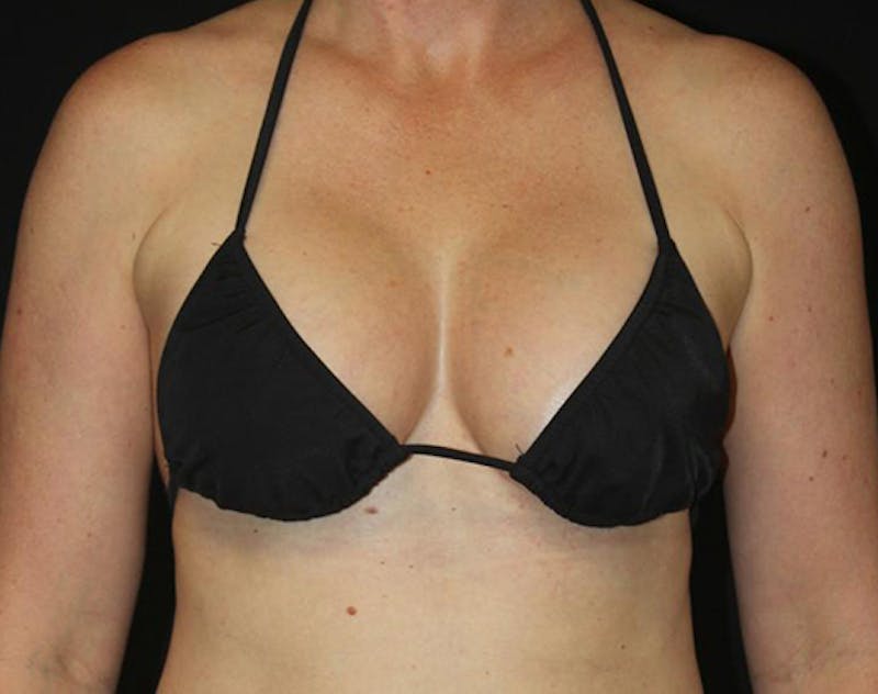 Breast Implants with Lift Before & After Gallery - Patient 169295 - Image 12