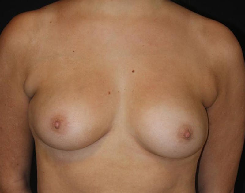 Breast Augmentation Before & After Gallery - Patient 423101 - Image 1
